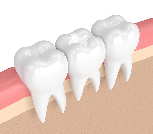 What is a tooth coloured match fillings | Ellwood Dental | General Dentist | SW Edmonton