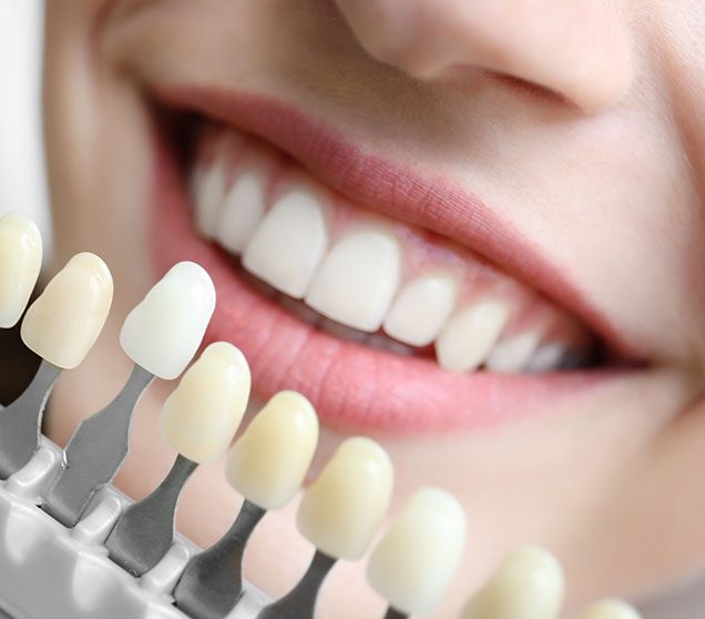 What is a Composite Veneer Porcelain Veneers | Ellwood Dental | General Dentist SW Edmonton