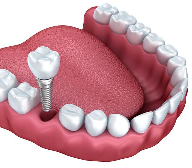 What is Oral Surgery | Ellwood Dental | General and Family Dentist SW Edmonton