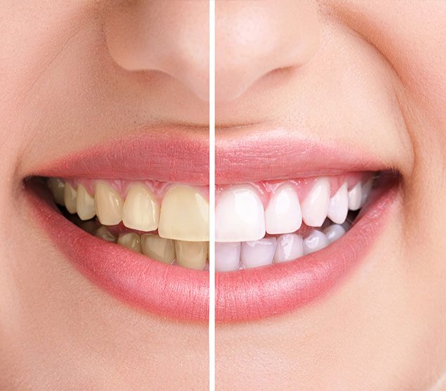 Teeth Whitening Treatment | Ellwood Dental | General and Family Dentist | SW Edmonton