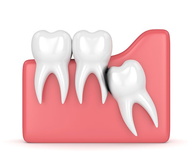 SW Edmonton Choice For Wisdom Teeth | Ellwood Dental | General and Family Dentist